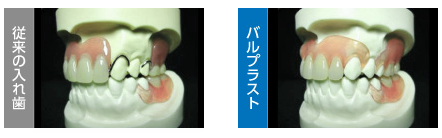 入れ歯・義歯